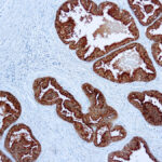 Immunohistochemical staining of Prostatic Acid Phosphatase  of human FFPE tissue followed by incubation with HRP labeled secondary and development with DAB substrate.