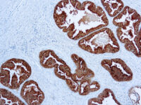 Immunohistochemical staining of Prostatic Acid Phosphatase  of human FFPE tissue followed by incubation with HRP labeled secondary and development with DAB substrate.