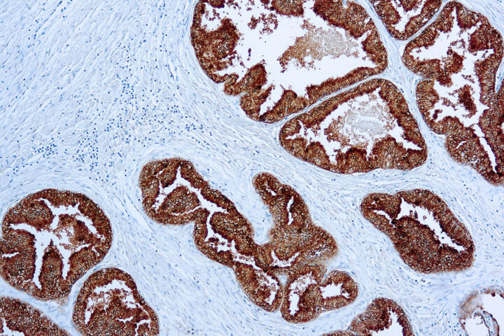 Immunohistochemical staining of Prostatic Acid Phosphatase  of human FFPE tissue followed by incubation with HRP labeled secondary and development with DAB substrate.