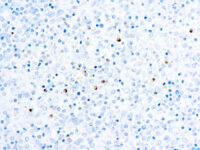 Immunohistochemical staining of Perforin  of human FFPE tissue followed by incubation with HRP labeled secondary and development with DAB substrate.