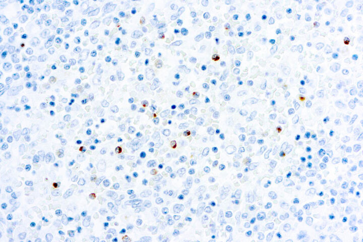 Immunohistochemical staining of Perforin  of human FFPE tissue followed by incubation with HRP labeled secondary and development with DAB substrate.