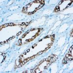 Immunohistochemical staining of Renal Cell Carcinoma  of human FFPE tissue followed by incubation with HRP labeled secondary and development with DAB substrate.