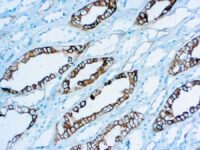 Immunohistochemical staining of Renal Cell Carcinoma  of human FFPE tissue followed by incubation with HRP labeled secondary and development with DAB substrate.