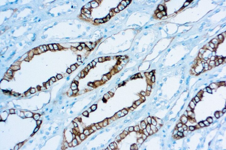 Immunohistochemical staining of Renal Cell Carcinoma  of human FFPE tissue followed by incubation with HRP labeled secondary and development with DAB substrate.