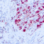 Immunohistochemical staining of S-100  of human FFPE tissue followed by incubation with HRP labeled secondary and development with DAB substrate.