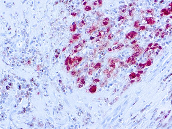 Immunohistochemical staining of S-100  of human FFPE tissue followed by incubation with HRP labeled secondary and development with DAB substrate.