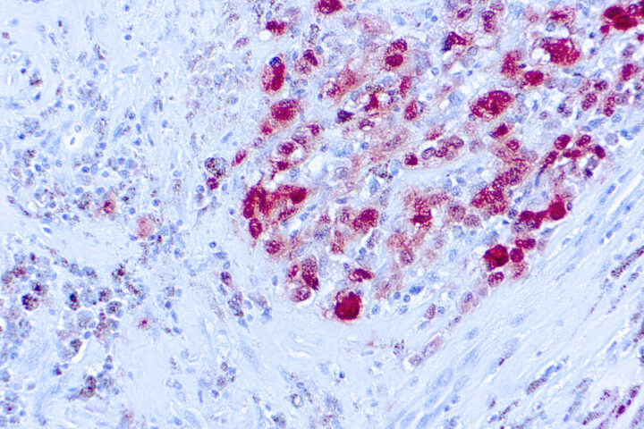 Immunohistochemical staining of S-100  of human FFPE tissue followed by incubation with HRP labeled secondary and development with DAB substrate.