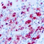 Immunohistochemical staining of S-100  of human FFPE tissue followed by incubation with HRP labeled secondary and development with DAB substrate.