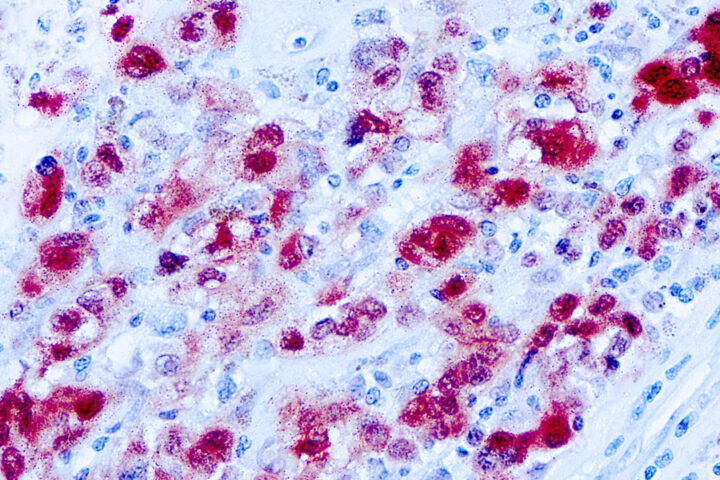 Immunohistochemical staining of S-100  of human FFPE tissue followed by incubation with HRP labeled secondary and development with DAB substrate.