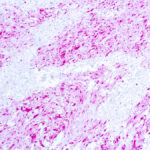 Immunohistochemical staining of S-100 Protein  of human FFPE tissue followed by incubation with HRP labeled secondary and development with DAB substrate.