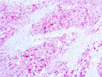 Immunohistochemical staining of S-100 Protein  of human FFPE tissue followed by incubation with HRP labeled secondary and development with DAB substrate.