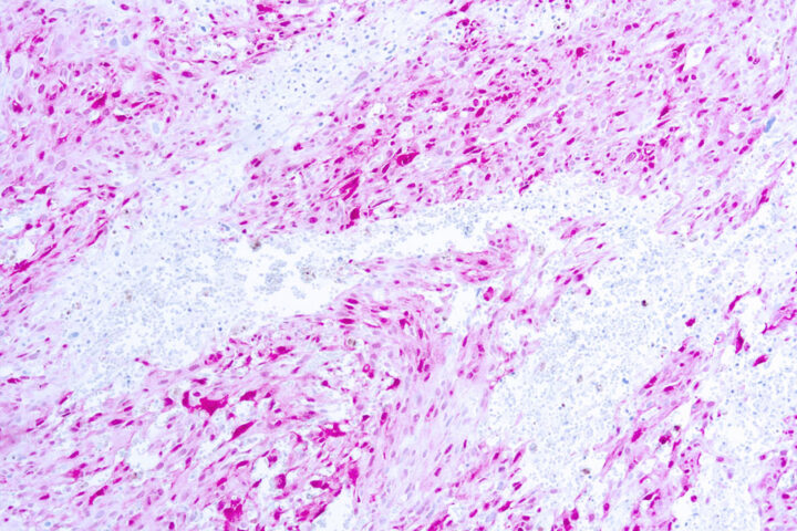 Immunohistochemical staining of S-100 Protein  of human FFPE tissue followed by incubation with HRP labeled secondary and development with DAB substrate.