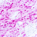 Immunohistochemical staining of S-100 Beta  of human FFPE tissue followed by incubation with HRP labeled secondary and development with DAB substrate.