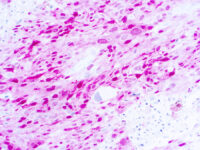 Immunohistochemical staining of S-100 Beta  of human FFPE tissue followed by incubation with HRP labeled secondary and development with DAB substrate.