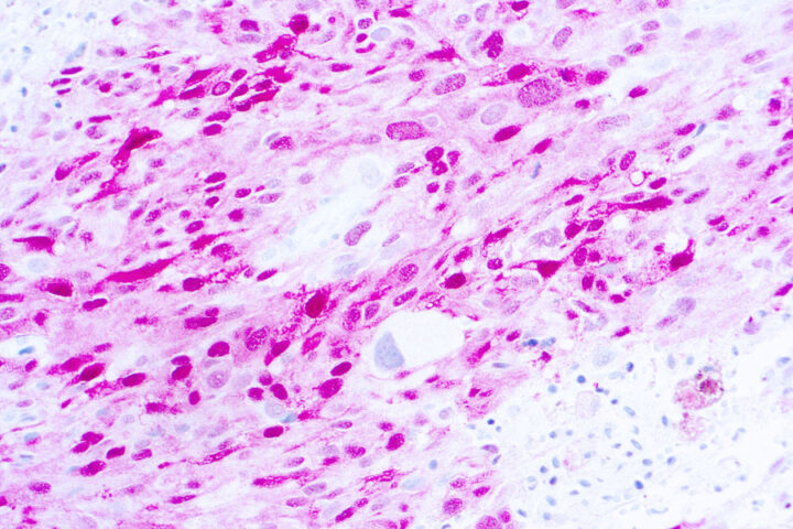 Immunohistochemical staining of S-100 Beta  of human FFPE tissue followed by incubation with HRP labeled secondary and development with DAB substrate.