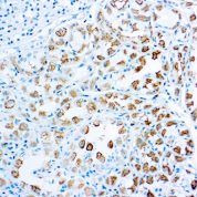 Immunohistochemical staining of Survivin  of human FFPE tissue followed by incubation with HRP labeled secondary and development with DAB substrate.
