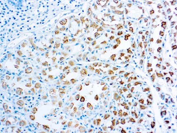Immunohistochemical staining of Survivin  of human FFPE tissue followed by incubation with HRP labeled secondary and development with DAB substrate.