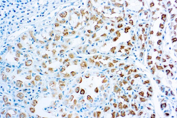 Immunohistochemical staining of Survivin  of human FFPE tissue followed by incubation with HRP labeled secondary and development with DAB substrate.