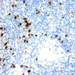 Immunohistochemical staining of Terminal Deoxynucleotidyl Transferase  of human FFPE tissue followed by incubation with HRP labeled secondary and development with DAB substrate.