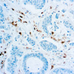 Immunohistochemical staining of Thymidine Phosphorylase/Platelet-Derived Endothelial Cell Growth Factor  of human FFPE tissue followed by incubation with HRP labeled secondary and development with DAB substrate.