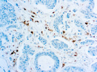 Immunohistochemical staining of Thymidine Phosphorylase/Platelet-Derived Endothelial Cell Growth Factor  of human FFPE tissue followed by incubation with HRP labeled secondary and development with DAB substrate.