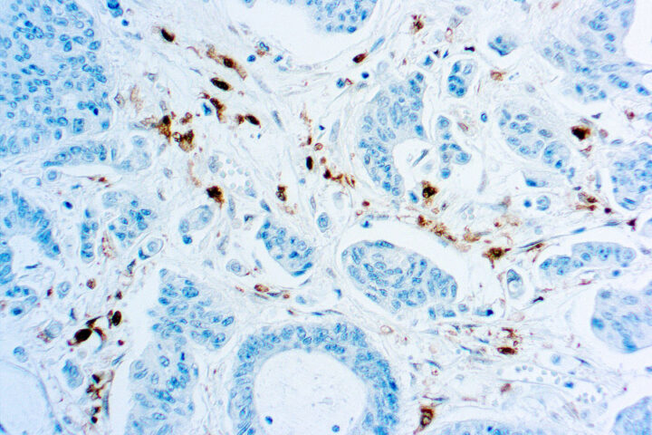 Immunohistochemical staining of Thymidine Phosphorylase/Platelet-Derived Endothelial Cell Growth Factor  of human FFPE tissue followed by incubation with HRP labeled secondary and development with DAB substrate.