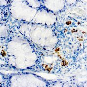 Immunohistochemical staining of TdT  of human FFPE tissue followed by incubation with HRP labeled secondary and development with DAB substrate.