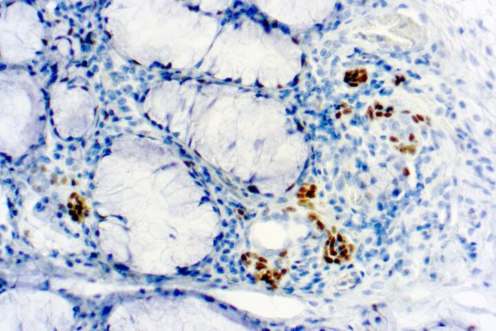 Immunohistochemical staining of TdT  of human FFPE tissue followed by incubation with HRP labeled secondary and development with DAB substrate.