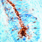 Immunohistochemical staining of TAG-72/CA 72-4  of human FFPE tissue followed by incubation with HRP labeled secondary and development with DAB substrate.