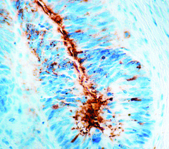 Immunohistochemical staining of TAG-72/CA 72-4  of human FFPE tissue followed by incubation with HRP labeled secondary and development with DAB substrate.