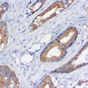 Immunohistochemical staining of TNF-alpha  of human FFPE tissue followed by incubation with HRP labeled secondary and development with DAB substrate.