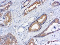 Immunohistochemical staining of TNF-alpha  of human FFPE tissue followed by incubation with HRP labeled secondary and development with DAB substrate.