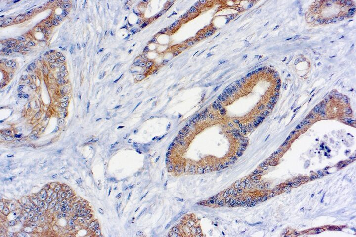 Immunohistochemical staining of TNF-alpha  of human FFPE tissue followed by incubation with HRP labeled secondary and development with DAB substrate.