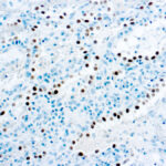 Immunohistochemical staining of Thyroid Transcription Factor-1, Thyroid and Lung Epithelial Marker  of human FFPE tissue followed by incubation with HRP labeled secondary and development with DAB substrate.