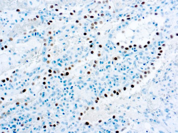 Immunohistochemical staining of Thyroid Transcription Factor-1, Thyroid and Lung Epithelial Marker  of human FFPE tissue followed by incubation with HRP labeled secondary and development with DAB substrate.