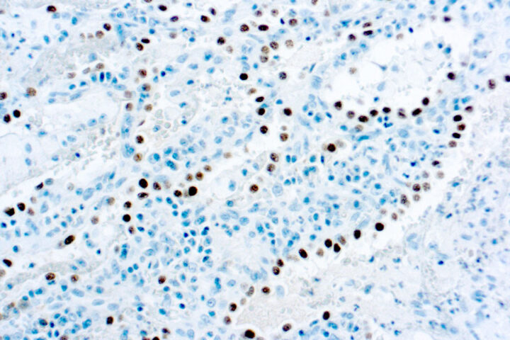 Immunohistochemical staining of Thyroid Transcription Factor-1, Thyroid and Lung Epithelial Marker  of human FFPE tissue followed by incubation with HRP labeled secondary and development with DAB substrate.