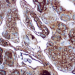 Immunohistochemical staining of Thyroglobulin  of human FFPE tissue followed by incubation with HRP labeled secondary and development with DAB substrate.