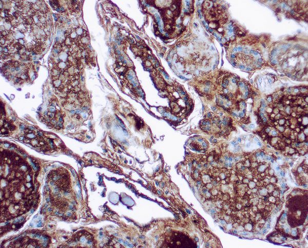 Immunohistochemical staining of Thyroglobulin  of human FFPE tissue followed by incubation with HRP labeled secondary and development with DAB substrate.