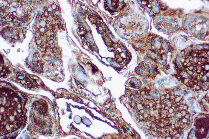 Immunohistochemical staining of Thyroglobulin  of human FFPE tissue followed by incubation with HRP labeled secondary and development with DAB substrate.