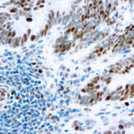 Immunohistochemical staining of Retinoblastoma Gene Protein  of human FFPE tissue followed by incubation with HRP labeled secondary and development with DAB substrate.