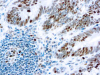 Immunohistochemical staining of Retinoblastoma Gene Protein  of human FFPE tissue followed by incubation with HRP labeled secondary and development with DAB substrate.