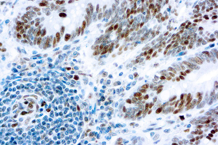 Immunohistochemical staining of Retinoblastoma Gene Protein  of human FFPE tissue followed by incubation with HRP labeled secondary and development with DAB substrate.