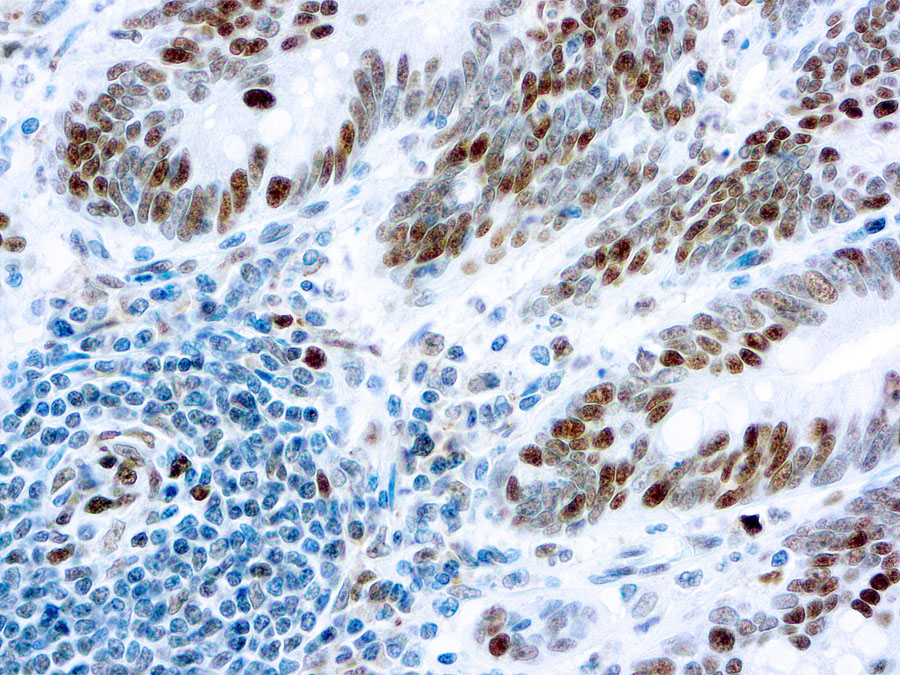 Immunohistochemical staining of Retinoblastoma Gene Protein  of human FFPE tissue followed by incubation with HRP labeled secondary and development with DAB substrate.