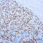 Immunohistochemical staining of SOX-10  of human FFPE tissue followed by incubation with HRP labeled secondary and development with DAB substrate.