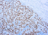 Immunohistochemical staining of SOX-10  of human FFPE tissue followed by incubation with HRP labeled secondary and development with DAB substrate.