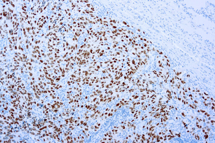 Immunohistochemical staining of SOX-10  of human FFPE tissue followed by incubation with HRP labeled secondary and development with DAB substrate.