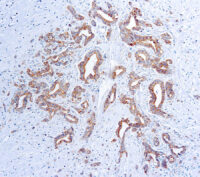 Immunohistochemical staining of Vascular Endothelial Growth Factor  of human FFPE tissue followed by incubation with HRP labeled secondary and development with DAB substrate.