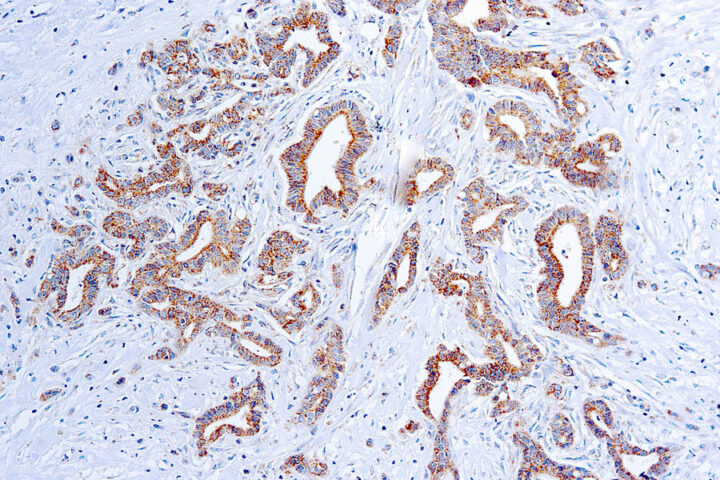 Immunohistochemical staining of Vascular Endothelial Growth Factor  of human FFPE tissue followed by incubation with HRP labeled secondary and development with DAB substrate.