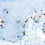 Immunohistochemical staining of Tyrosinase, Melanoma Marker  of human FFPE tissue followed by incubation with HRP labeled secondary and development with DAB substrate.