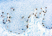 Immunohistochemical staining of Tyrosinase, Melanoma Marker  of human FFPE tissue followed by incubation with HRP labeled secondary and development with DAB substrate.